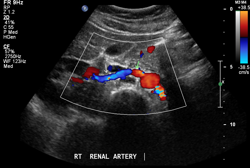 What is renal artery ultrasound?