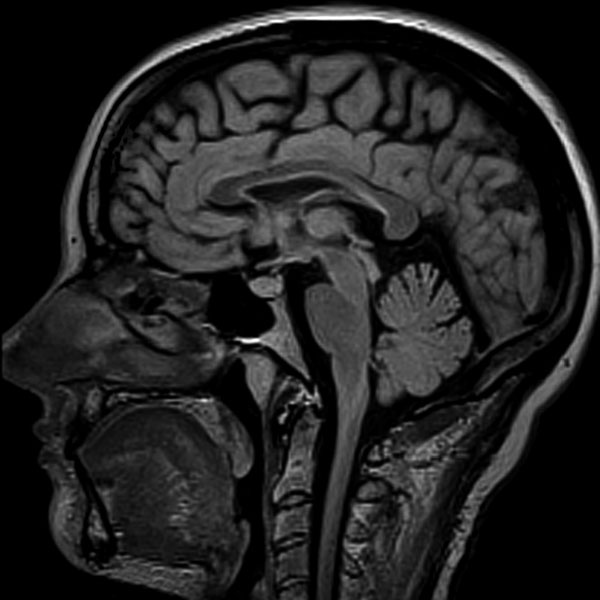 Image depicting an MRI sagittal slice of the Brain for display purposes only
