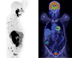 PET/CT - Canberra Imaging Group