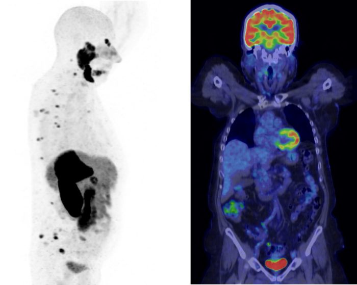 An image of a PET study showing PET data and Fused PET/CT data