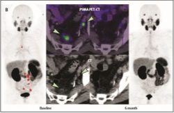 Prostate-specific membrane antigen PET-CT